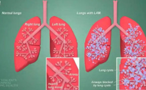 肺靶向和肝靶向LNPs的結(jié)構(gòu)差異，及其在mRNA遞送中的應(yīng)用