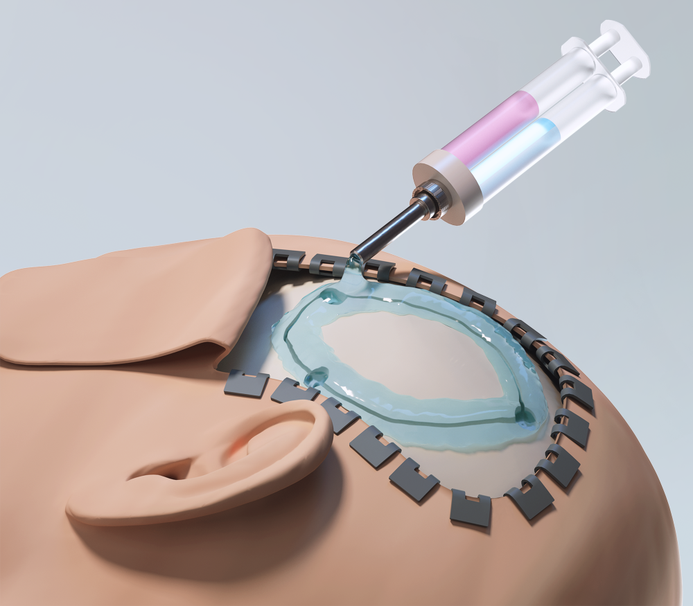 聚乙二醇化水凝膠